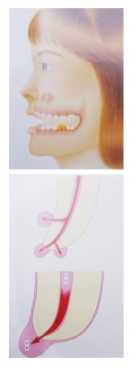 歯内治療とは